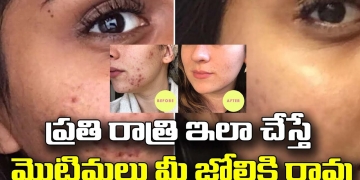 ప్రతి రాత్రి ఇలా చేస్తే మొటిమలు మీ జోలికి రావు | Pimples Treatment in Telugu | Skin Care Tips